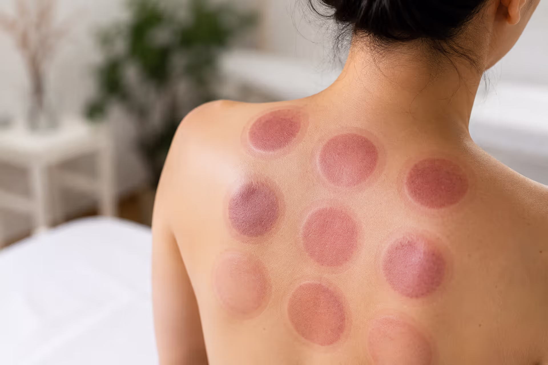 How Long Do Cupping Marks Last After Treatment